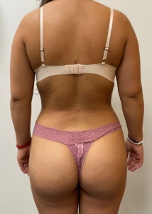 Brazilian-Butt-Lift-Case--367 | After Brazilian Butt Lift 1