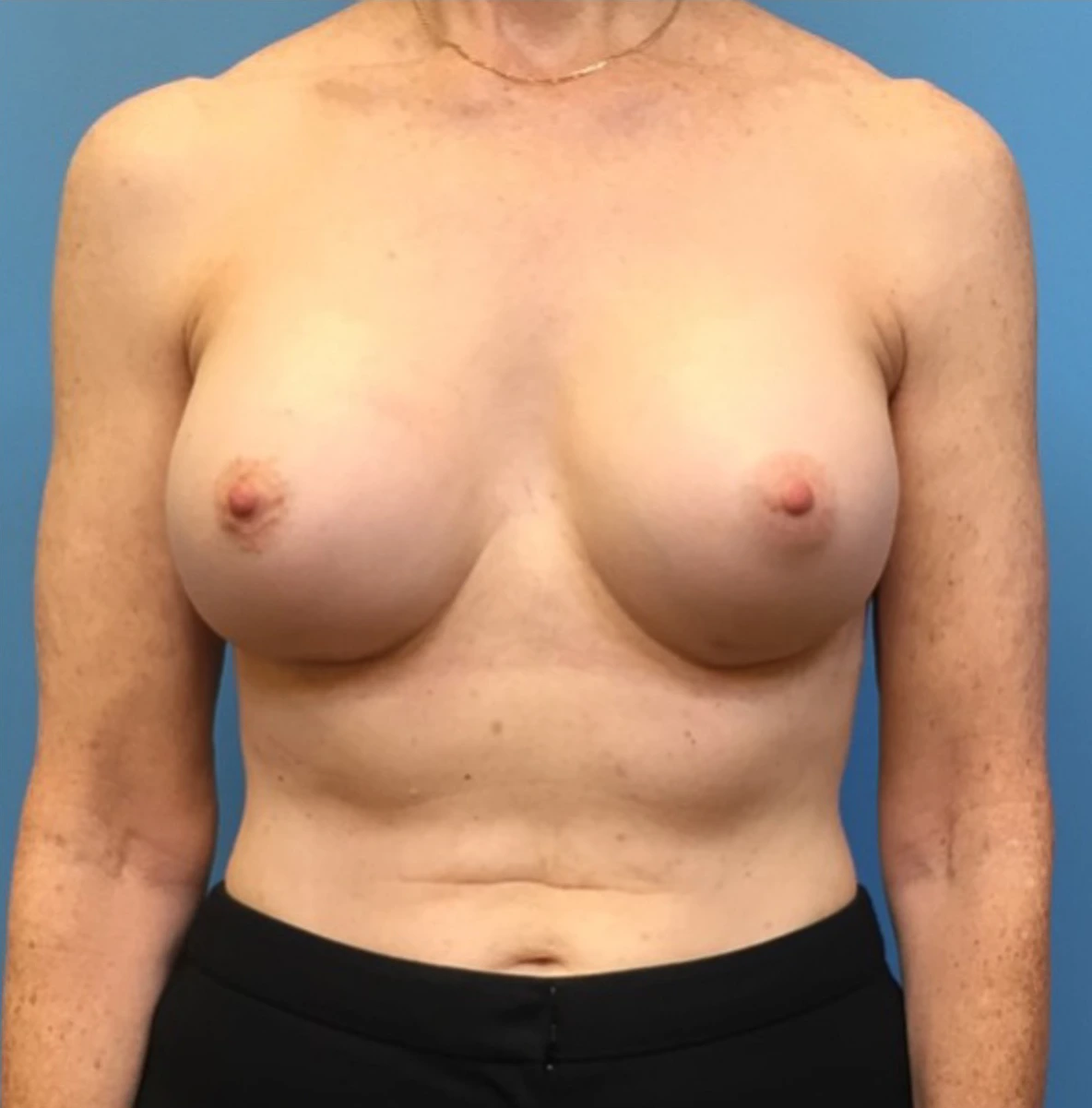 Revision-Augmentation-Case--236 | After Revision Augmentation 1