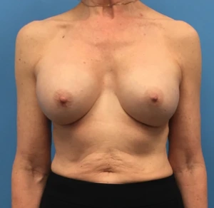 Revision-Breast-Augmentation-Case--237 | After Dr. Samir Rao 1