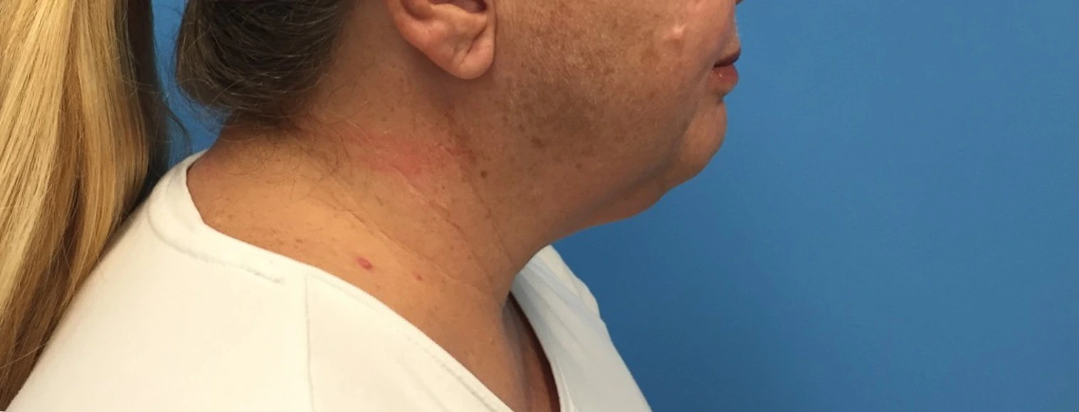 Case--391 | After Submental Liposuction 1