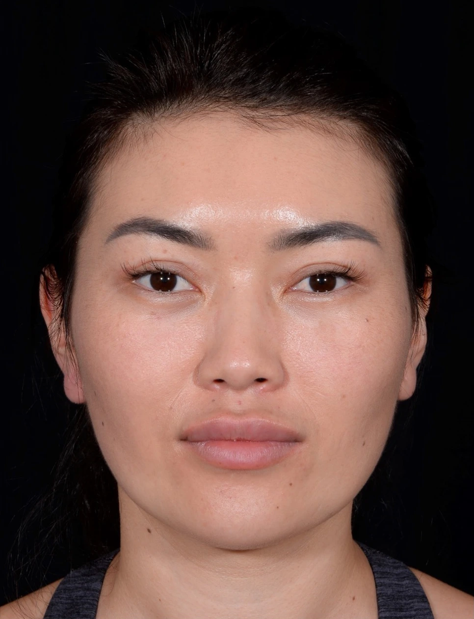 Blepharoplasty-Case--356 | After Eyelid Surgery 4