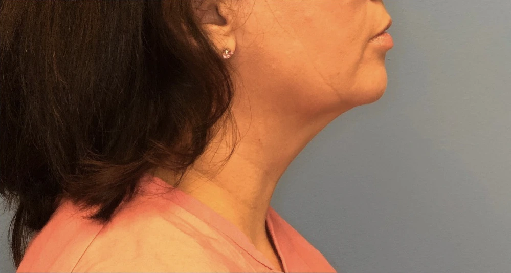 Case--392 | After Submental Liposuction 1