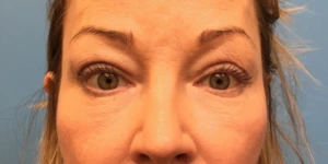 Upper-Blepharoplasty-Case--393 | After Eyelid Surgery 1