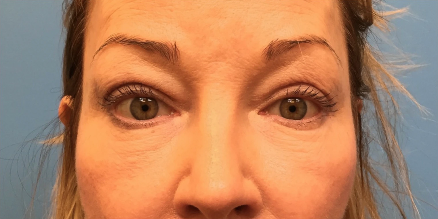 Upper-Blepharoplasty-Case--393 | After Eyelid Surgery 1