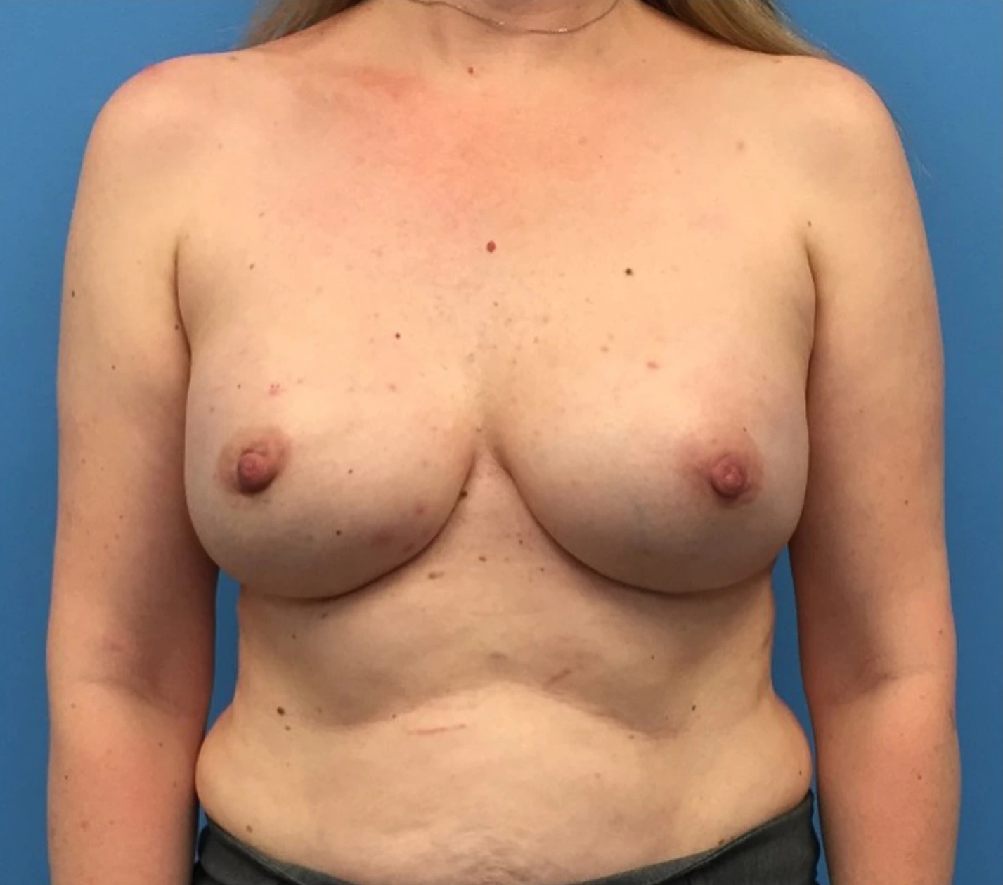 Breast-Reconstruction-Case--295 | After Breast Reconstruction 1