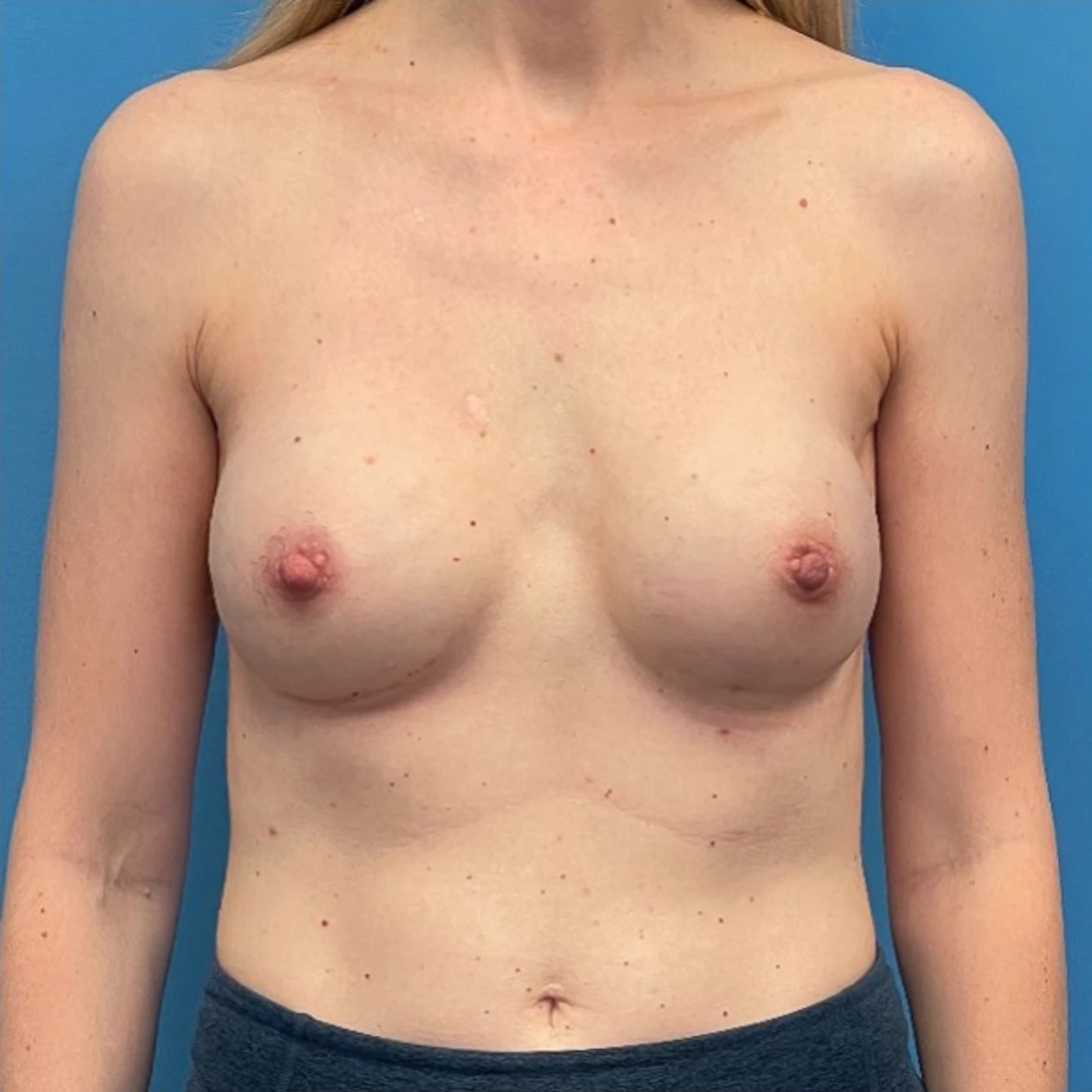 Breast-Reconstruction-Case--298 | After Breast Reconstruction 1