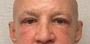 Blepharoplasty-Case--24169 | After Eyelid Surgery 1