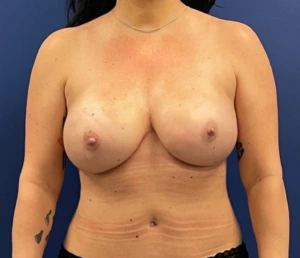 Breast-Reconstruction-Case--306 | After Dr. Samir Rao 1