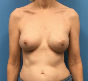 Breast-Reconstruction-Case--313 | After Dr. Samir Rao 1