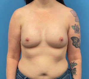 Breast-Reconstruction-Case--335 | After Dr. Samir Rao 1