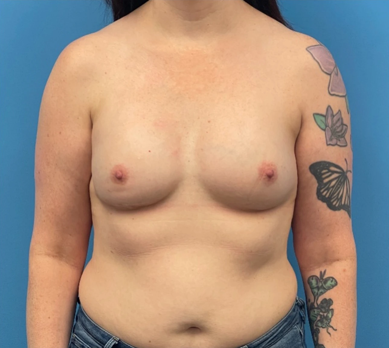 Breast-Reconstruction-Case--335 | After Breast Reconstruction 1