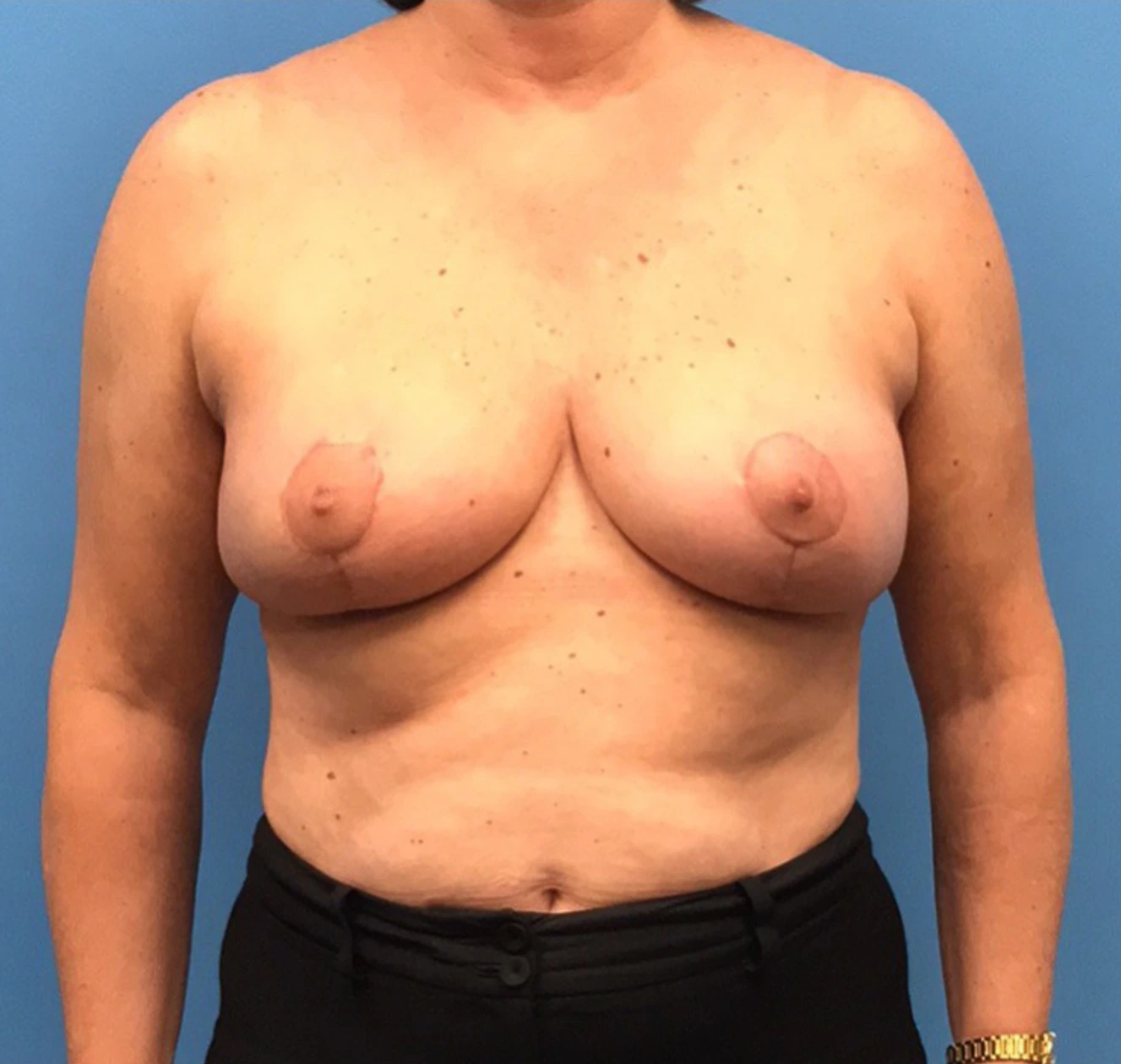 Case--314 | After Breast Reconstruction 1