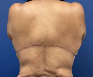 Body-Lift-Case--274 | After Dr. Samir Rao 1