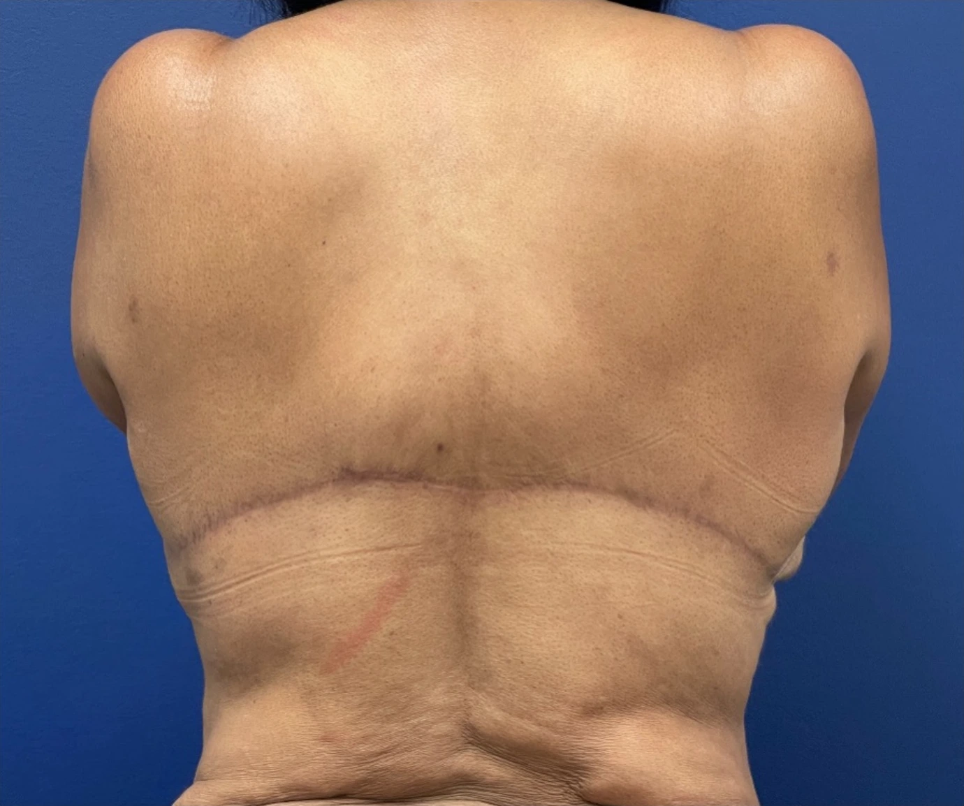 Body-Lift-Case--274 | After Body Lift 1