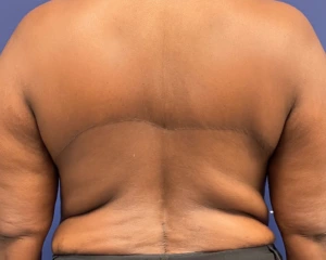 Body-Lift-Case--275 | After Dr. Samir Rao 1