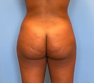 Brazilian-Butt-Lift-Case--263 | After Brazilian Butt Lift 1