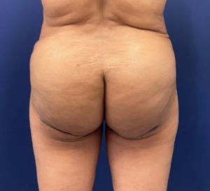Brazilian-Butt-Lift-Case--215 | After Brazilian Butt Lift 1