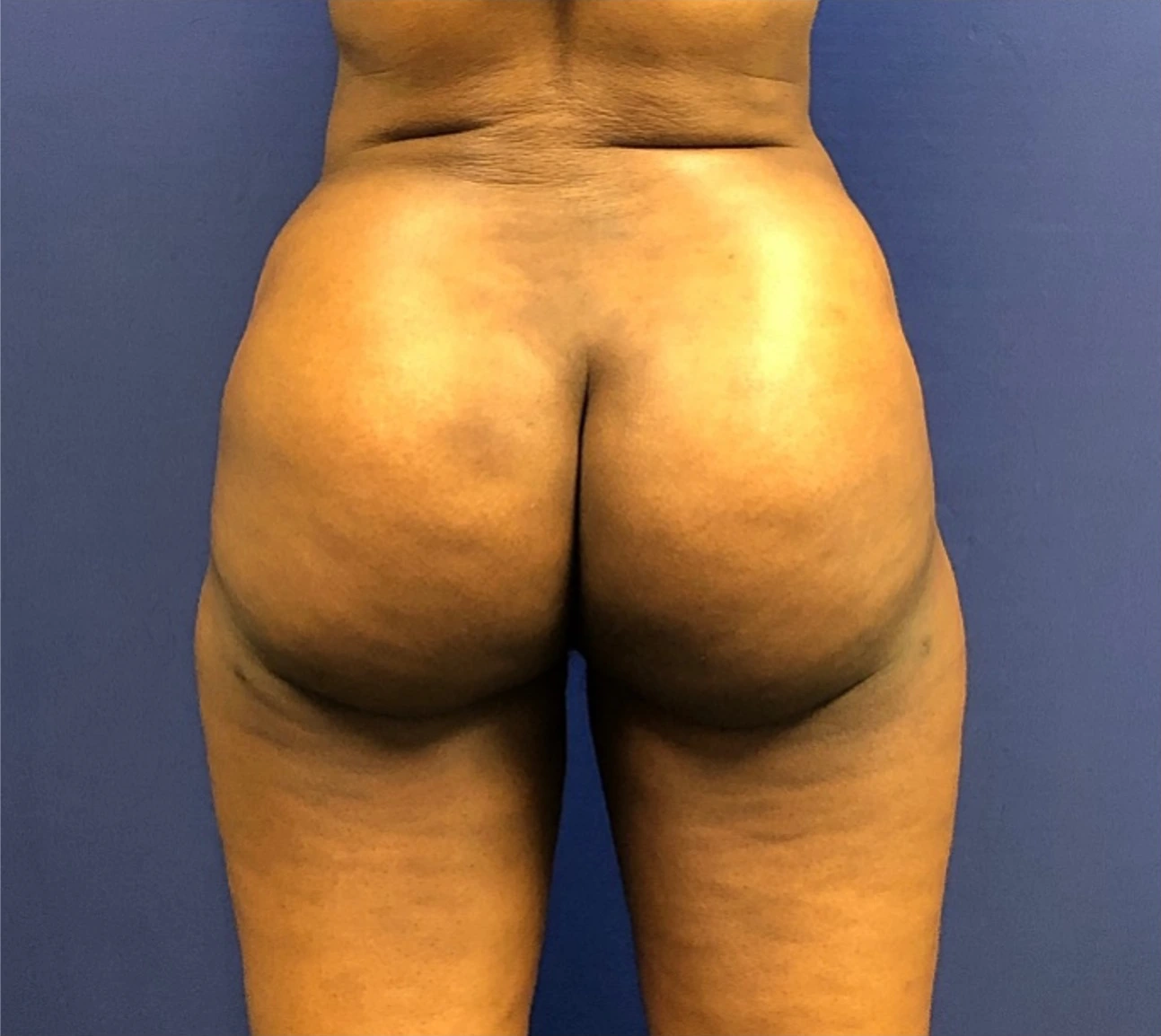 Brazilian-Butt-Lift-Case--267 | After Brazilian Butt Lift 3