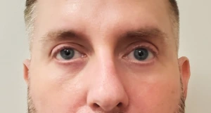 Lower-Blepharoplasty-Case--359 | After Eyelid Surgery 2