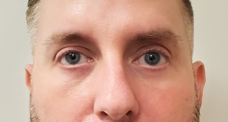 Lower-Blepharoplasty-Case--359 | After Eyelid Surgery 2