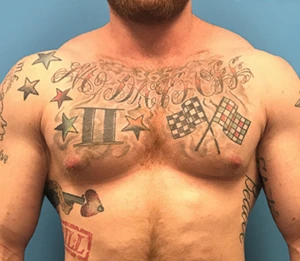 Gynecomastia-Case--143 | After Gynecomastia / Male Breast Reduction 1