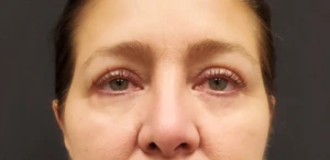 Quad-Blepharoplasty-Case--358 | After Eyelid Surgery 2