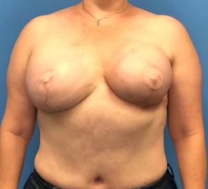 Case--10685 | After Breast 1