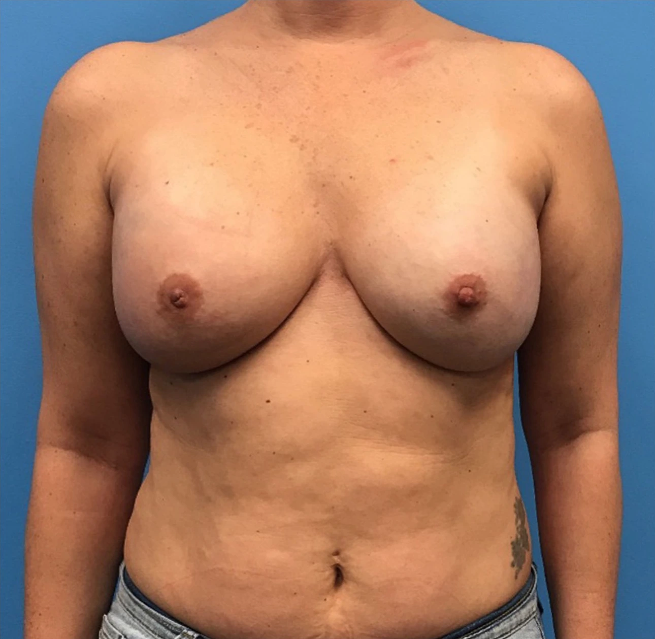 Case--299 | After Breast Reconstruction 1