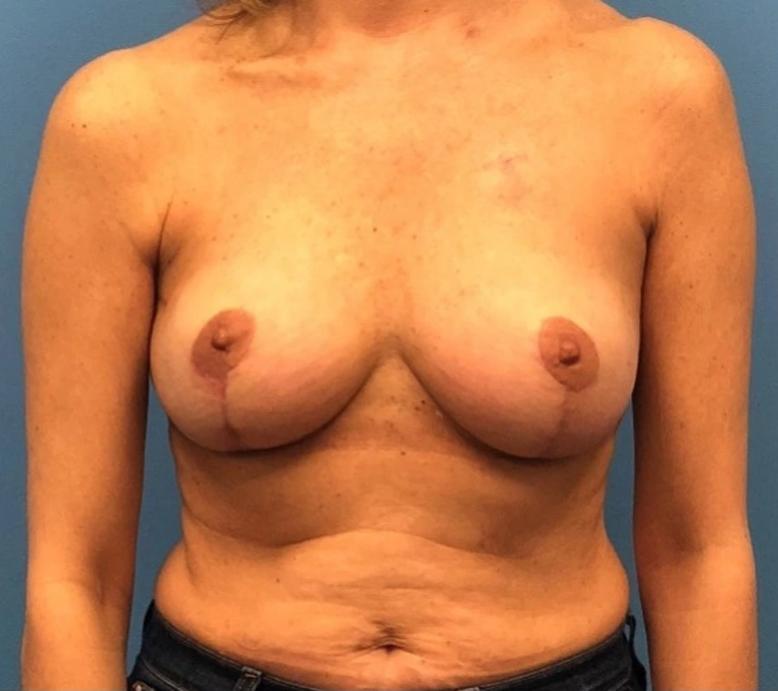 Case--334 | After Breast Reconstruction 1