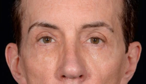 Quad-Blepharoplasty-Case--357 | After Eyelid Surgery 2