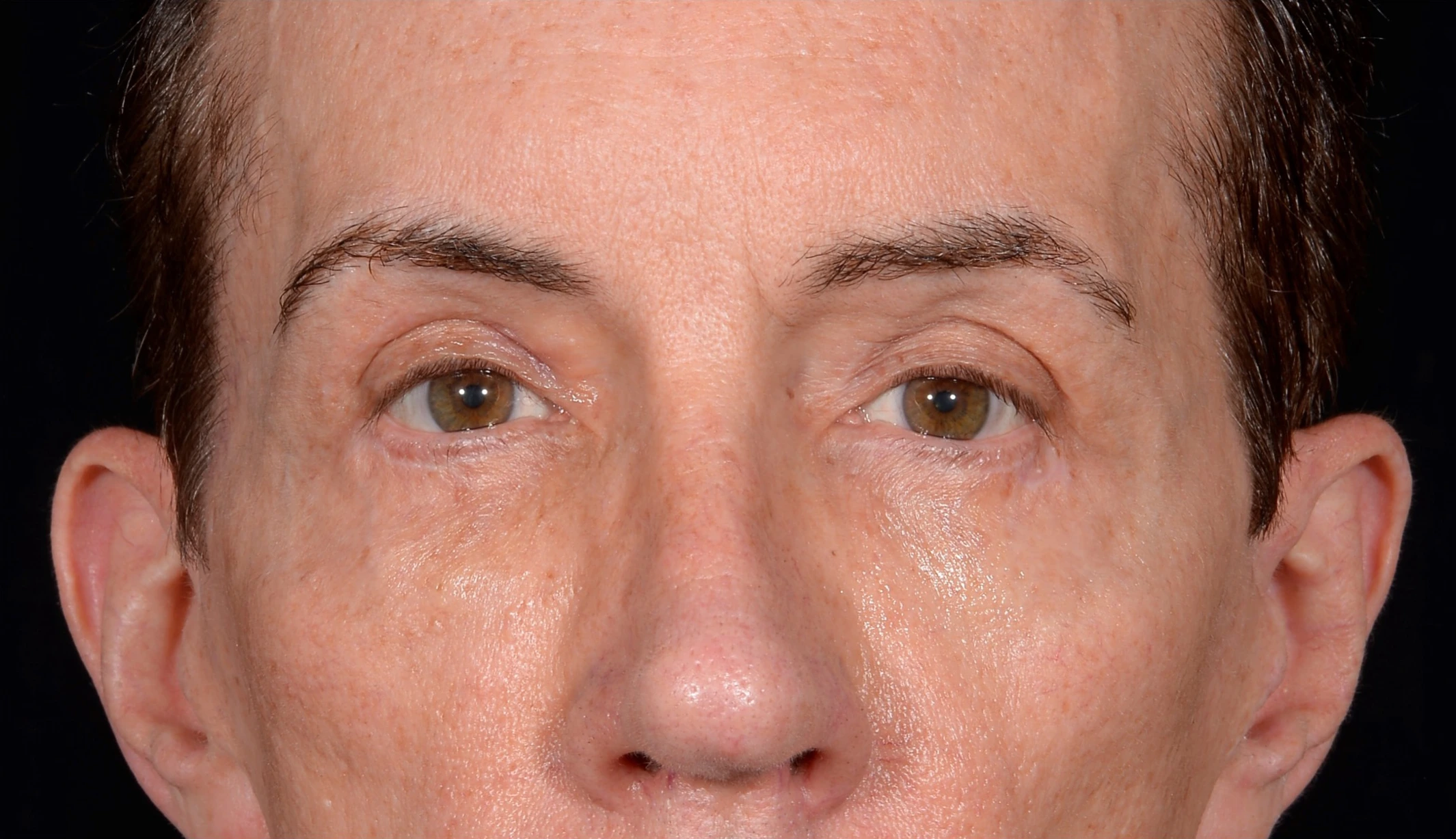 Quad-Blepharoplasty-Case--357 | After Eyelid Surgery 2