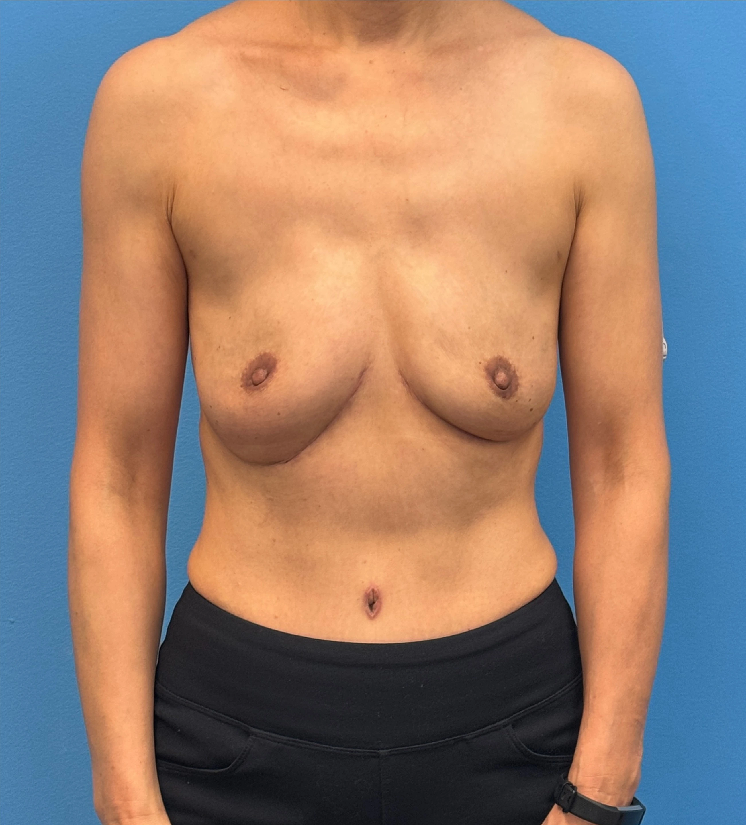 Diep-Flap-Procedure | After DIEP Flap 1