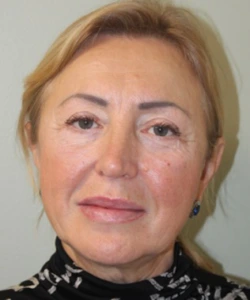 Facelift-Case--401 | After Facelift 1