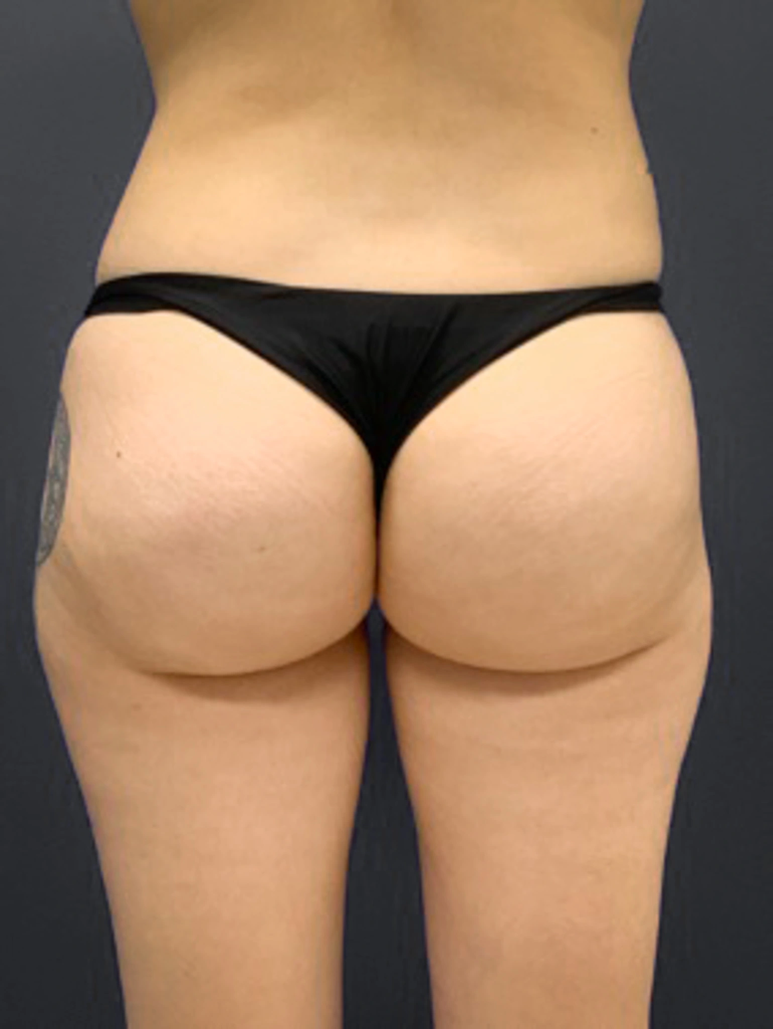 Aveli-Case--6987 | After Aveli/AlloClae/J-Plasma 1