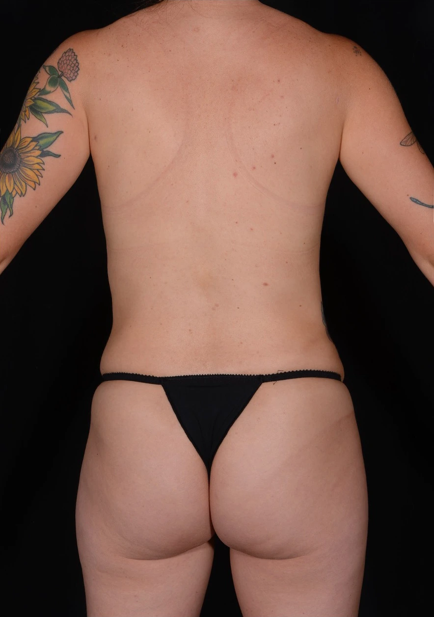 Case--383 | After Tummy Tuck 6