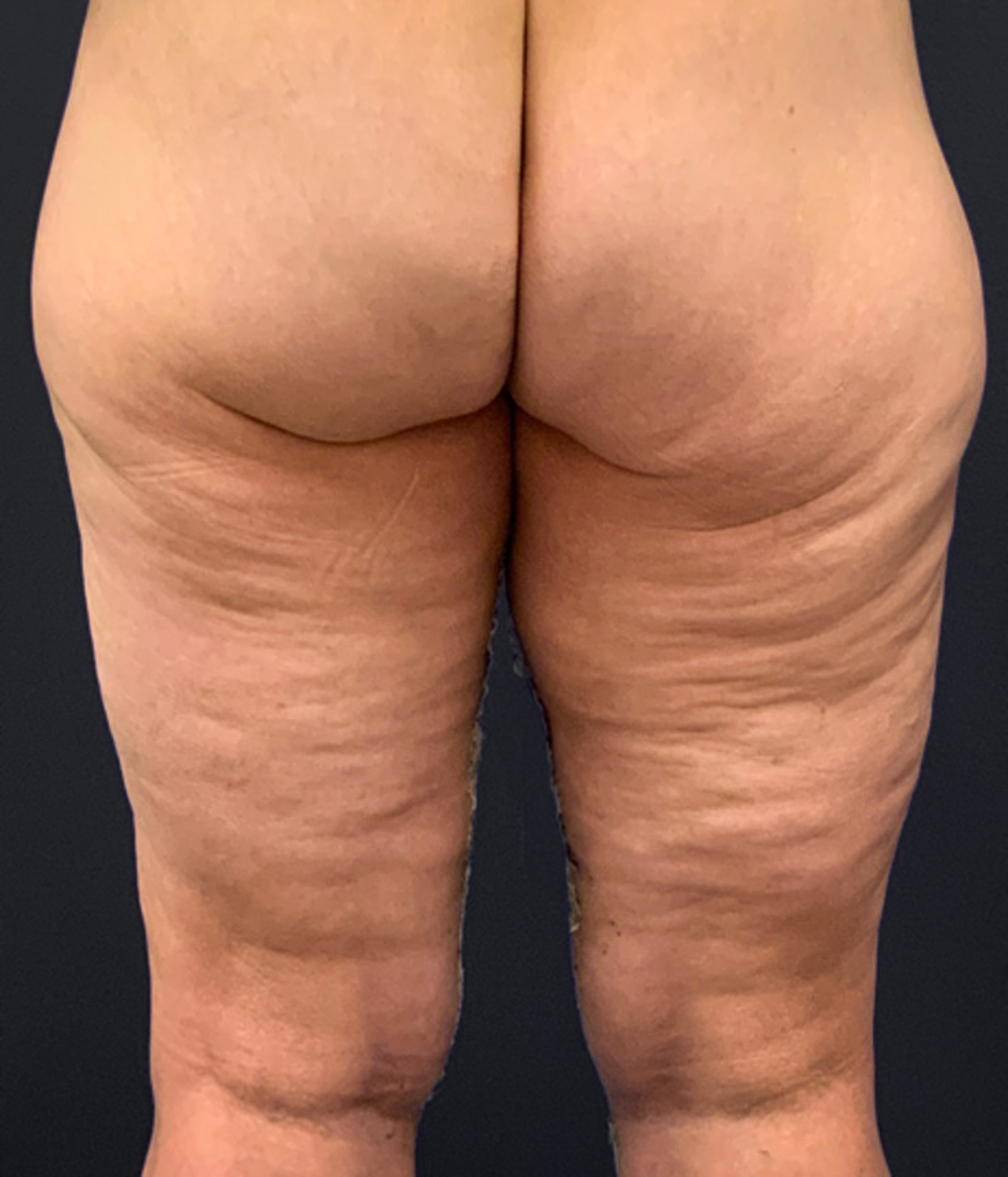 Thighplasty-Case--2024 | After Thigh Lift 4
