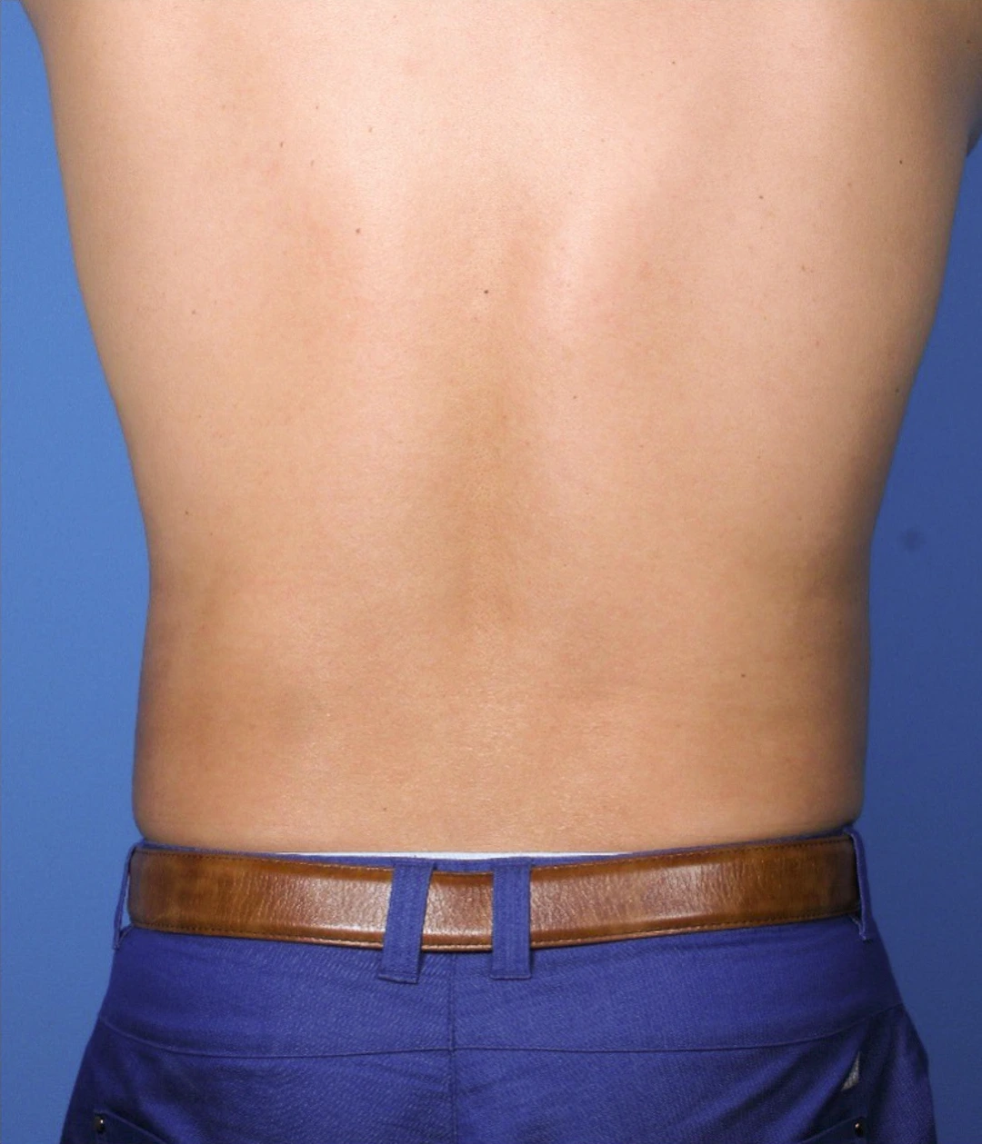 Case--389 | After Liposuction 3