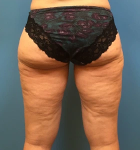 Case--281 | After Liposuction 2