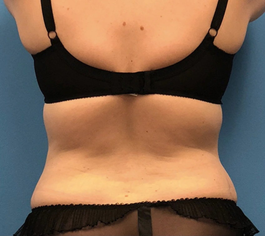 Case--56 | After Liposuction 4