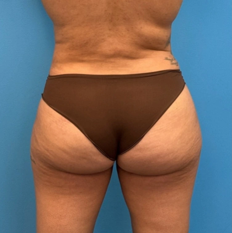 Case--25704 | After Liposuction 2