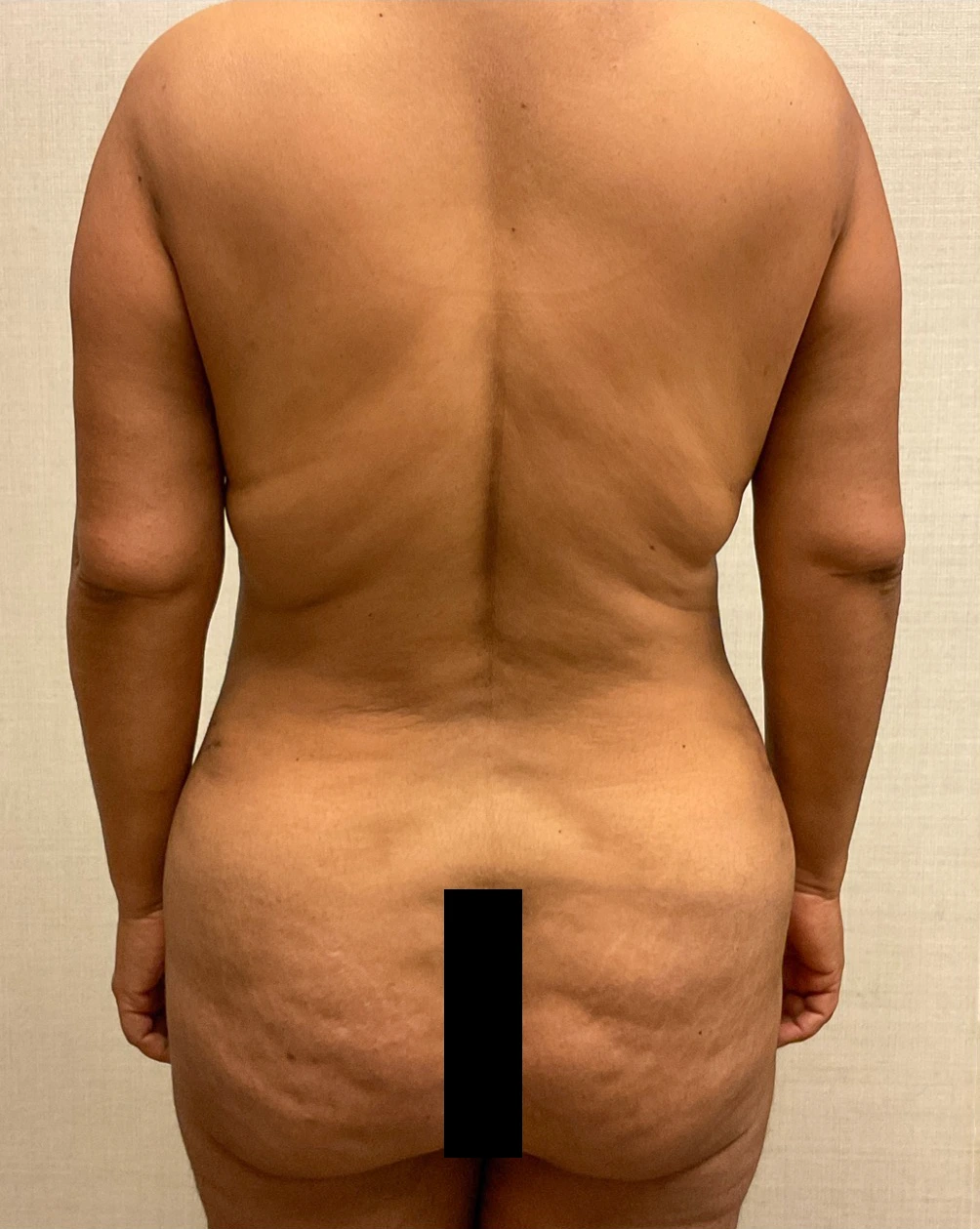 Liposuction-Abdominoplasty-Case--25576 | After Liposuction 6