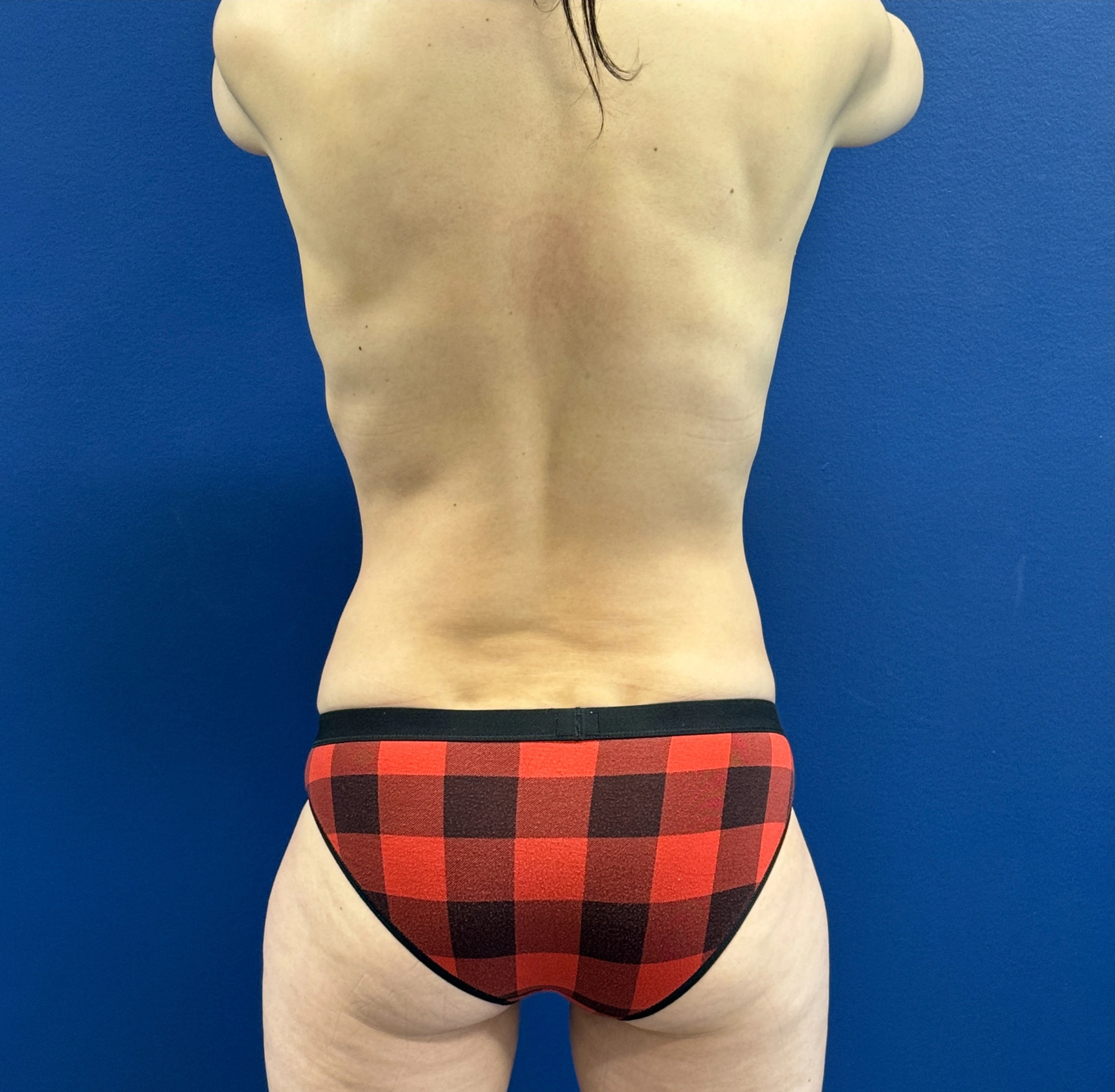 Breast-Augmentation-Lift-Case--28152 | After Breast Augmentation With Lift 5