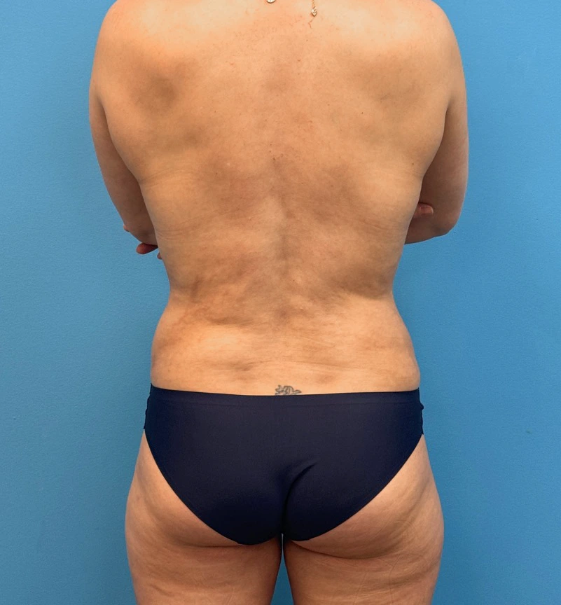 Breast-Augmentation-Tummy-Tuck-Case--28080 | After Body Lift 5