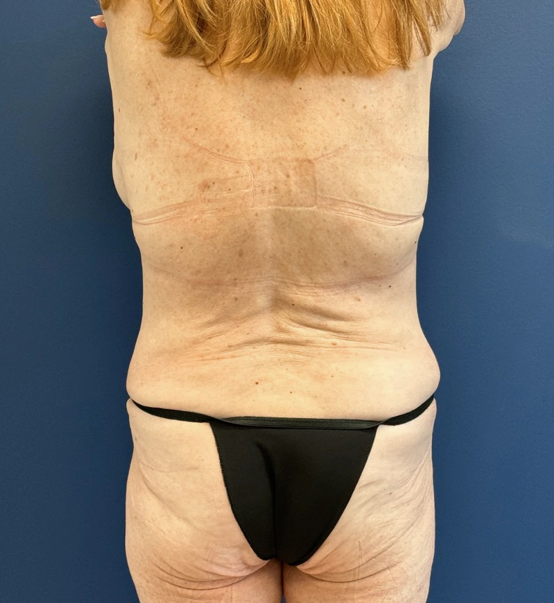 Lipoabdominoplasty-Case--27935 | After Liposuction 4