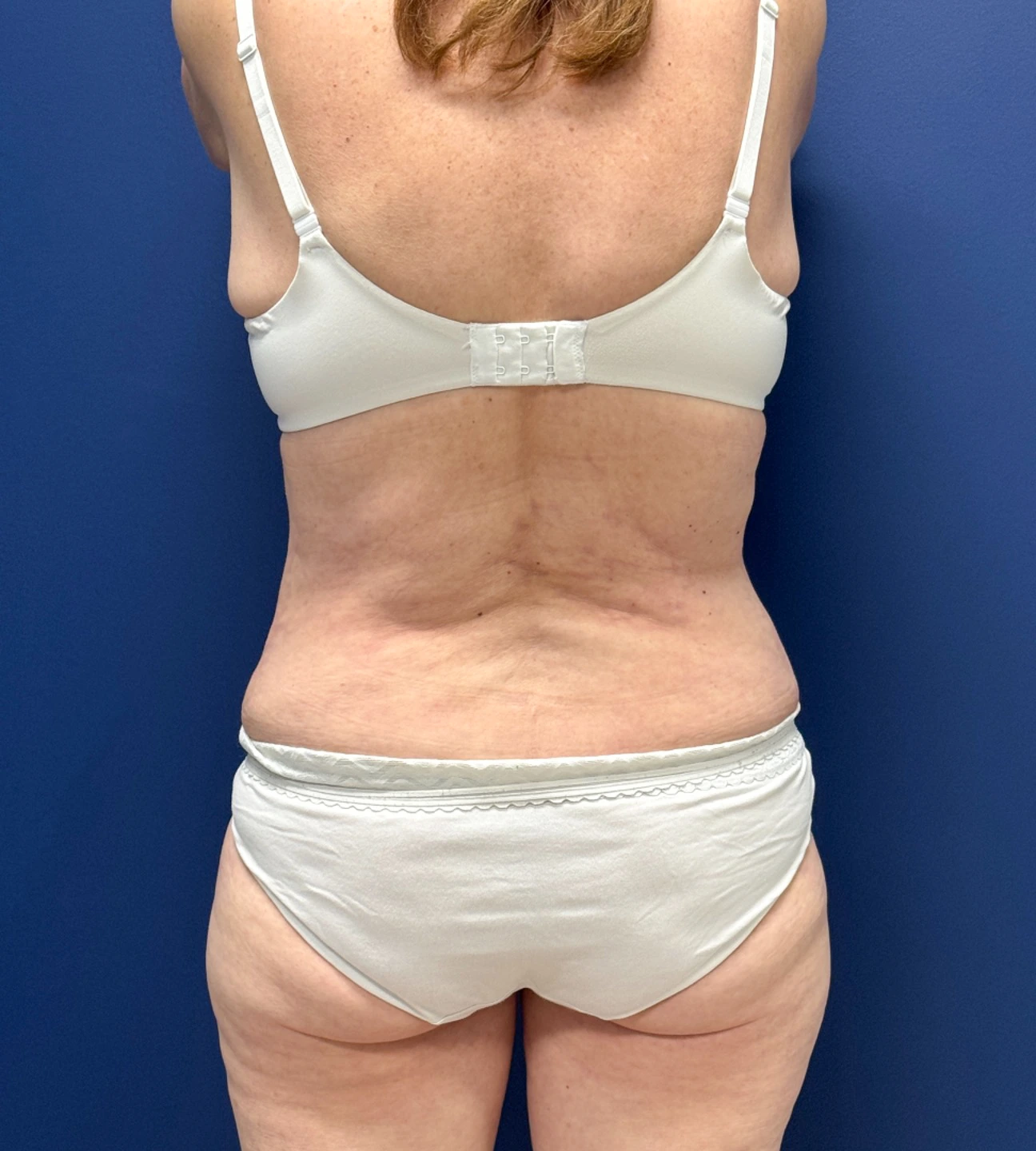 Abdominoplasty-Case--23690 | After Liposuction 3