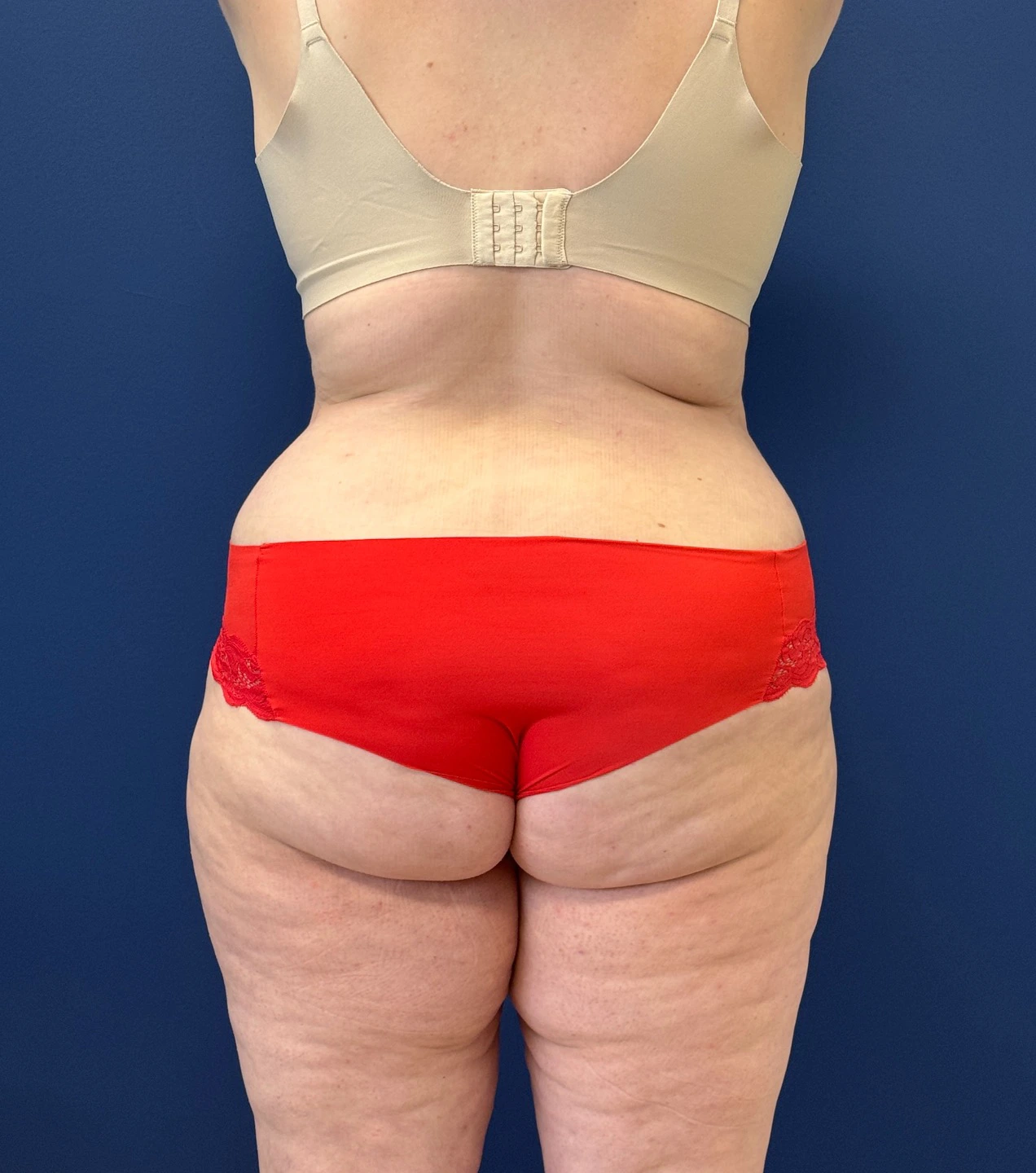 Tummy-Tuck-Case--28426 | After Tummy Tuck 4