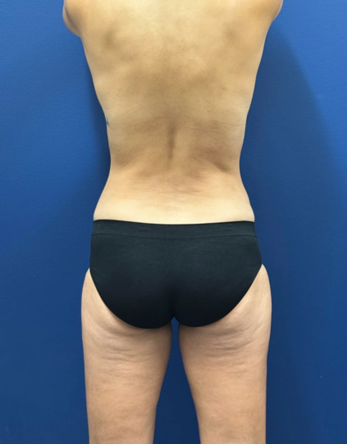 Breast-Augmentation-Tummy-Tuck-Case--29010 | After Breast Augmentation With Lift 5