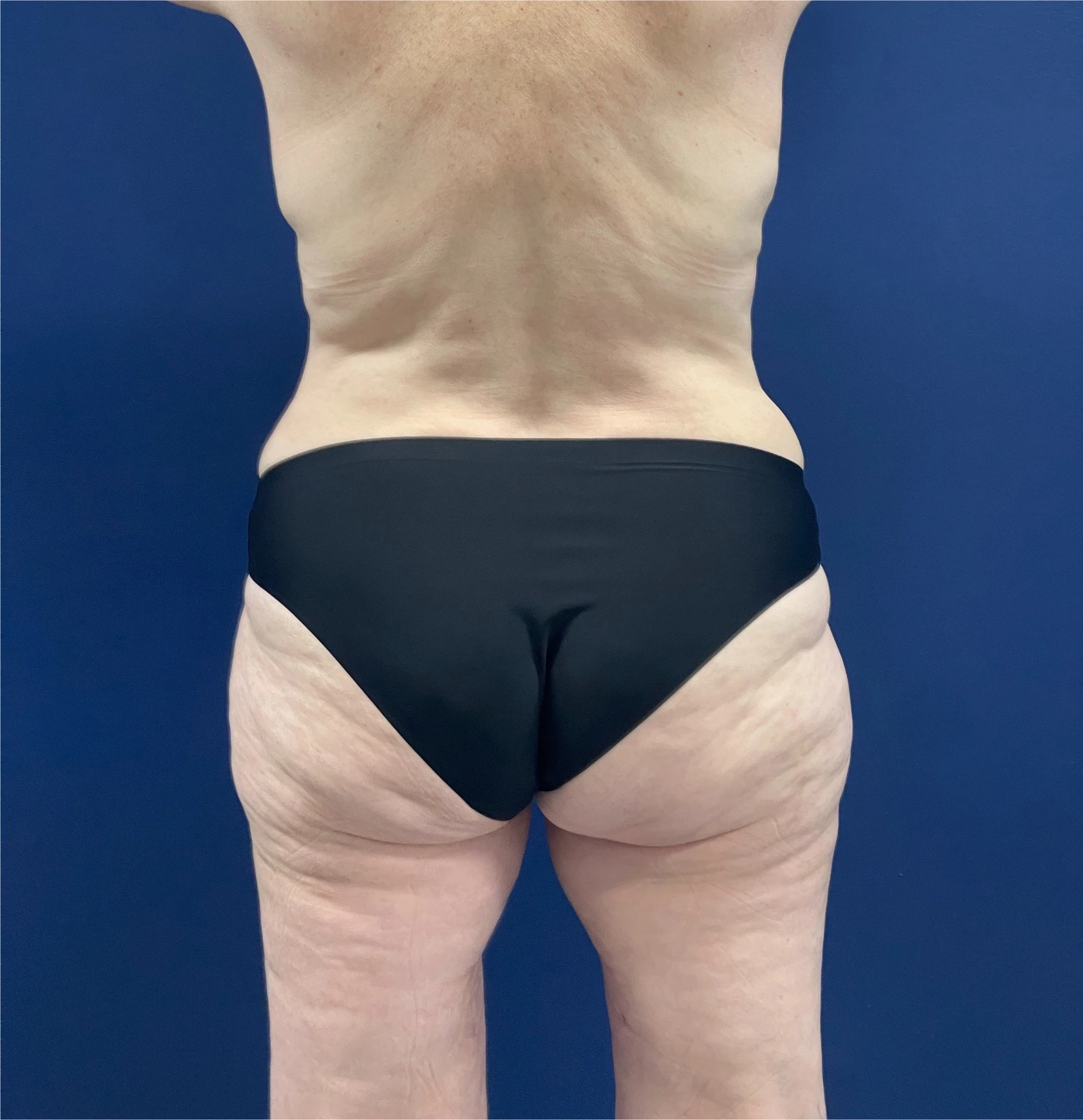 Mommy-Makeover-Case--26853 | After Mommy Makeover 4