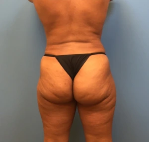 Case--247 | After Liposuction 2