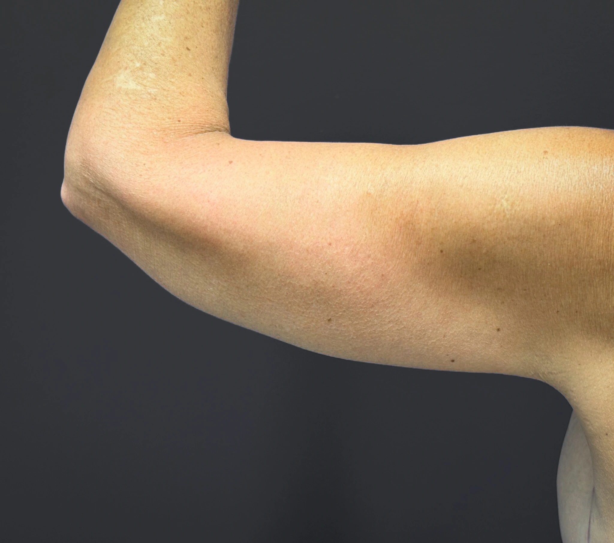 Brachioplasty-Case--6382 | After Arm Lift 4